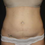 Liposuction Before & After Patient #28106