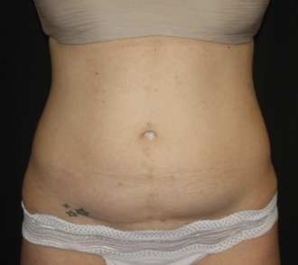 Liposuction Before & After Patient #28106