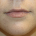 Lip Augmentation Before & After Patient #27909