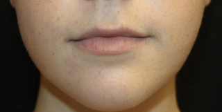 Lip Augmentation Before & After Patient #27909