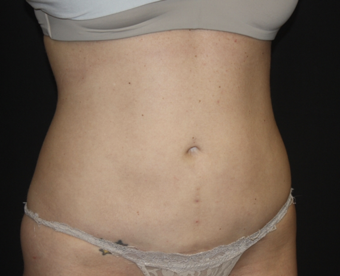 Liposuction Before & After Patient #28106