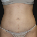 Liposuction Before & After Patient #28106