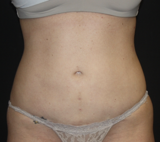 Liposuction Before & After Patient #28106