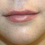 Lip Augmentation Before & After Patient #27909