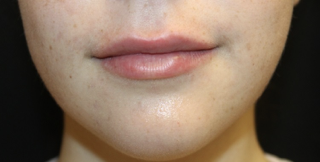 Lip Augmentation Before & After Patient #27909