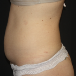 Liposuction Before & After Patient #28106