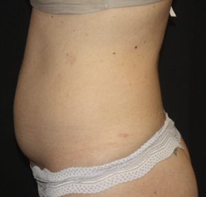 Liposuction Before & After Patient #28106