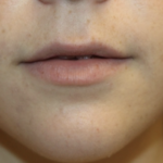 Lip Augmentation Before & After Patient #27909