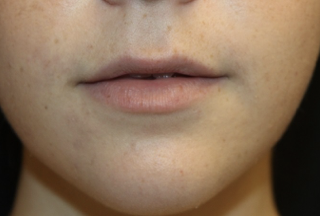 Lip Augmentation Before & After Patient #27909