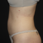 Liposuction Before & After Patient #28106