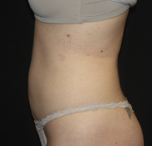 Liposuction Before & After Patient #28106