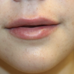 Lip Augmentation Before & After Patient #27909