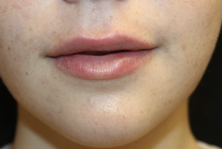 Lip Augmentation Before & After Patient #27909