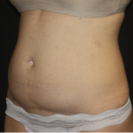 Liposuction Before & After Patient #28106