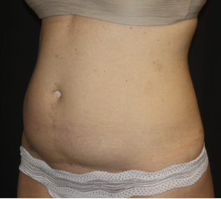 Liposuction Before & After Patient #28106