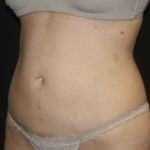 Liposuction Before & After Patient #28106