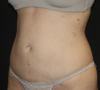 Liposuction Before & After Patient #28106