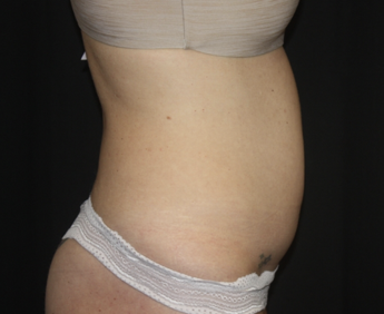 Liposuction Before & After Patient #28106