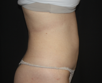 Liposuction Before & After Patient #28106