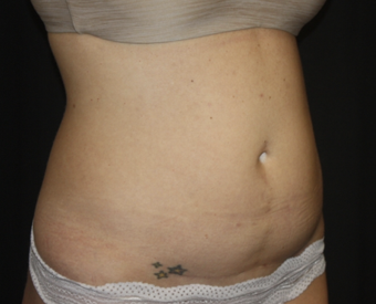 Liposuction Before & After Patient #28106