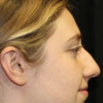 Rhinoplasty Before & After Patient #28007