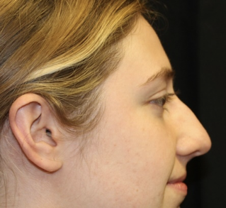 Rhinoplasty Before & After Patient #28007