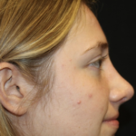 Rhinoplasty Before & After Patient #28007