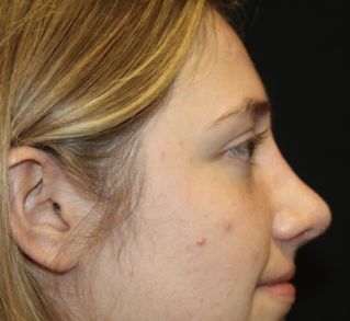 Rhinoplasty Before & After Patient #28007