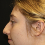 Rhinoplasty Before & After Patient #28007
