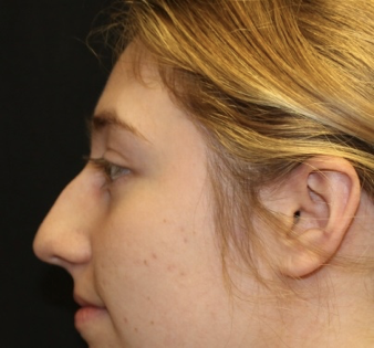 Rhinoplasty Before & After Patient #28007