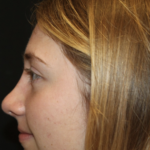 Rhinoplasty Before & After Patient #28007