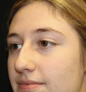 Rhinoplasty Before & After Patient #28007