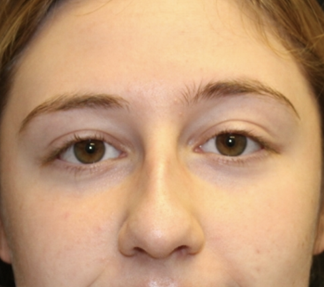 Rhinoplasty Before & After Patient #28007