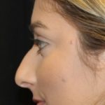 Rhinoplasty Before & After Patient #28207