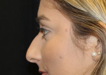 Rhinoplasty Before & After Patient #28207