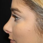 Rhinoplasty Before & After Patient #28207