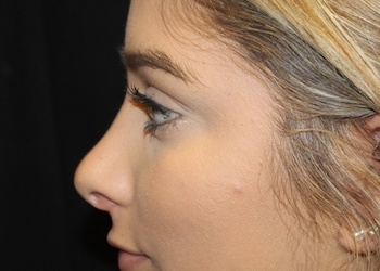 Rhinoplasty Before & After Patient #28207