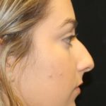 Rhinoplasty Before & After Patient #28207