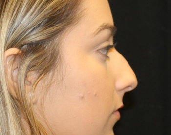 Rhinoplasty Before & After Patient #28207