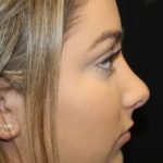 Rhinoplasty Before & After Patient #28207