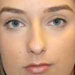 Rhinoplasty Before & After Patient #28207