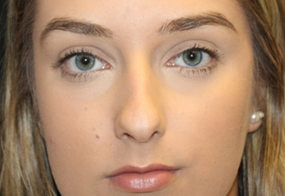 Rhinoplasty Before & After Patient #28207