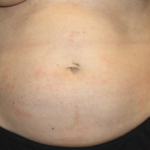 Tummy Tuck Before & After Patient #28029