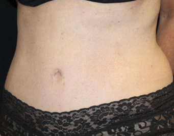 Tummy Tuck Before & After Patient #28029