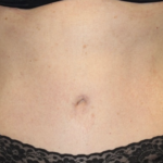 Tummy Tuck Before & After Patient #28029