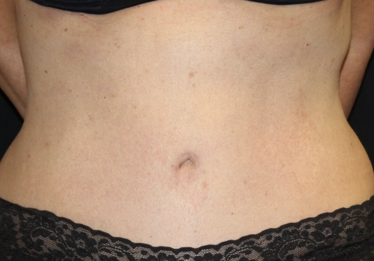 Tummy Tuck Before & After Patient #28029