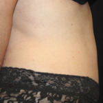 Tummy Tuck Before & After Patient #28029
