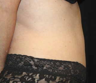 Tummy Tuck Before & After Patient #28029