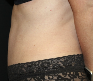 Tummy Tuck Before & After Patient #28029