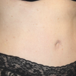 Tummy Tuck Before & After Patient #28029